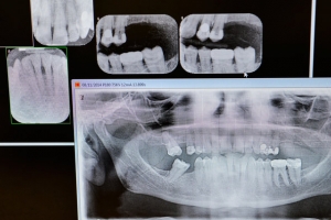 dental-x-ray-tmagArticle