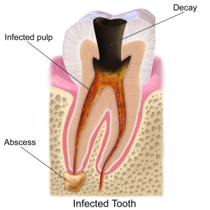 Tooth decay