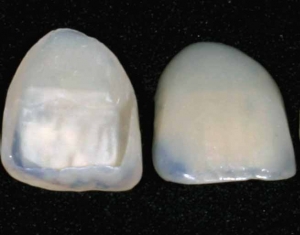 Dental_veneer