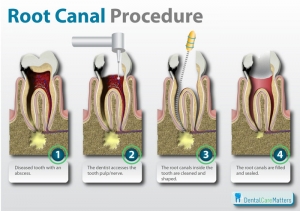 Root-canal-procedure